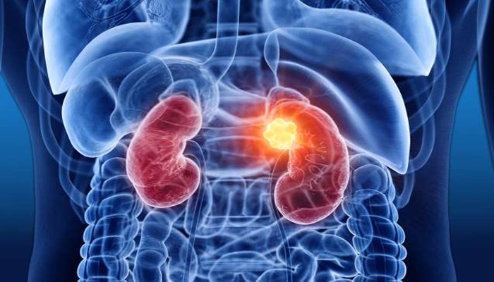 देश में बढ़ा Kidney cancer का खतरा, जानें कैसे करें बचाव?